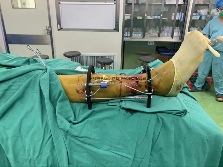 【望京醫院】不開刀治骨折病例分享——右脛骨遠端骨折 【望京醫院】不開刀治骨折病例分享——右脛骨遠端骨折